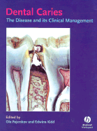 Dental Caries
