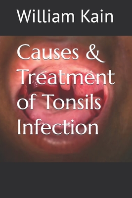 Causes & Treatment of Tonsils Infection - Kain, William