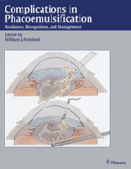 Complications in Phacoemulsification: Avoidance, Recognition and Management