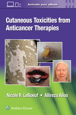 Cutaneous Toxicities from Anticancer Therapies - LeBoeuf, Nicole, Dr., and Alloo, Allireza, Dr.