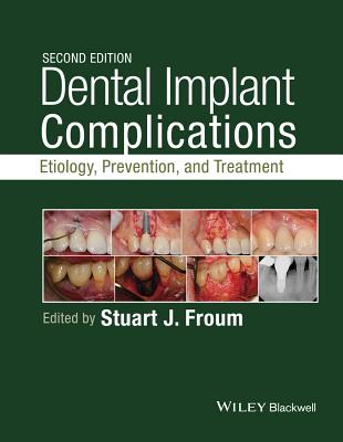 Dental Implant Complications: Etiology, Prevention, and Treatment - Froum, Stuart J. (Editor)