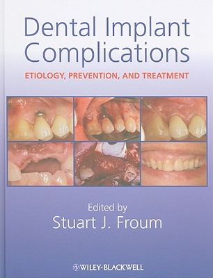 Dental Implant Complications - Froum