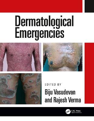 Dermatological Emergencies - Verma, Rajesh (Editor), and Vasudevan, Biju (Editor)