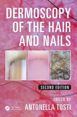 Dermoscopy of the Hair and Nails - Tosti, Antonella (Editor)