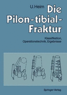 Die Pilon-Tibial-Fraktur: Klassifikation, Operationstechnik, Ergebnisse