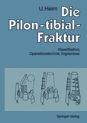 Die Pilon-Tibial-Fraktur: Klassifikation, Operationstechnik, Ergebnisse - Allgwer, M (Foreword by), and G?chter, A, and Heim, Urs