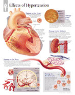 Effects of Hypertension