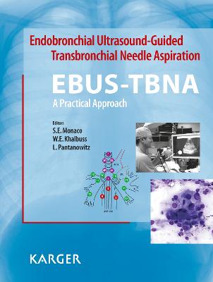 Endobronchial Ultrasound-Guided Transbronchial Needle Aspiration (EBUS-TBNA): A Practical Approach - Monaco, S.E. (Editor), and Khalbuss, W.E. (Editor), and Pantanowitz, L. (Editor)