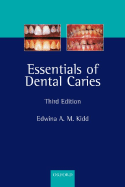 Essentials of Dental Caries: The Disease and Its Management