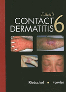 Fisher's Contact Dermatitis