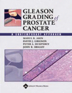 Gleason Grading of Prostate Cancer: A Contemporary Approach