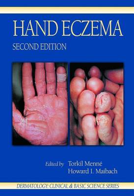 Hand Eczema, Second Edition - Menne, Torkil (Editor), and Maibach, Howard I, MD (Editor)