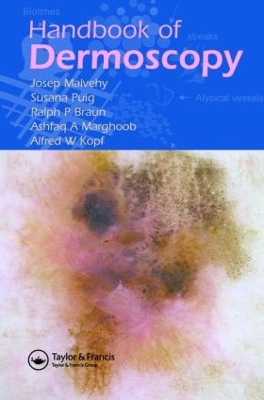 Handbook of Dermoscopy - Malvehy, Josep, and Braun, Ralph P, and Puig, Susana