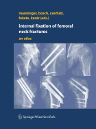 Internal Fixation of Femoral Neck Fractures: An Atlas