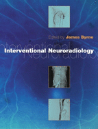 Interventional Neuroradiology: Theory and Practice