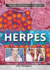 Herpes (Your Sexual Health)