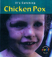 It's Catching: Chicken Pox