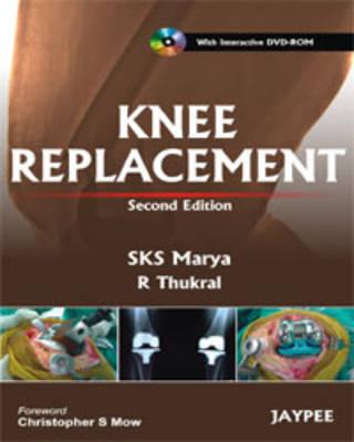 Knee Replacement - Marya, SKS