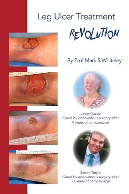 Leg Ulcer Treatment Revolution - Whiteley, Mark S