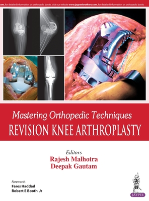 Mastering Orthopedic Techniques: Revision Knee Arthroplasty - Malhotra, Rajesh, and Gautam, Deepak