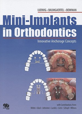 Mini-Implants in Orthodontics: Innovative Anchorage Concepts - Ludwig, Bjorn, and Baumgaertel, Sebastian, and Bohm, Bernhard