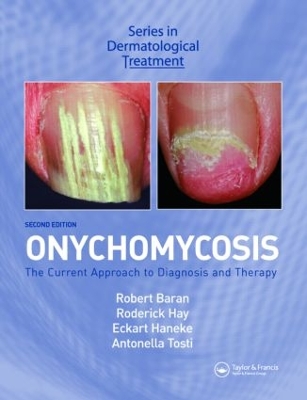 Onychomycosis: The Current Approach to Diagnosis and Therapy - Baran, Robert (Editor), and Hay, Roderick (Editor), and Tosti, Antonella (Editor)