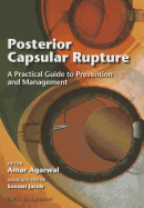 Posterior Capsular Rupture: A Practical Guide to Prevention and Management
