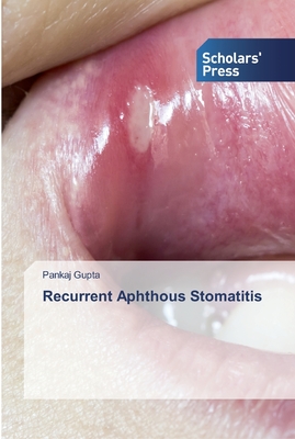 Recurrent Aphthous Stomatitis - Gupta, Pankaj