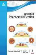 Simplified Phacoemulsification