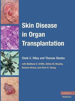 Skin Disease in Organ Transplantation - Otley, Clark C (Editor), and Stasko, Thomas (Editor)