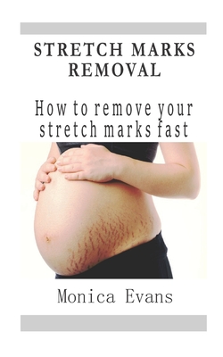 Stretch Marks Removal: How to remove your stretch marks fast - Evans, Monica