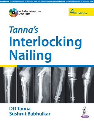 Tanna's Interlocking Nailing - Tanna, DD, and Babhulkar, Sushrut