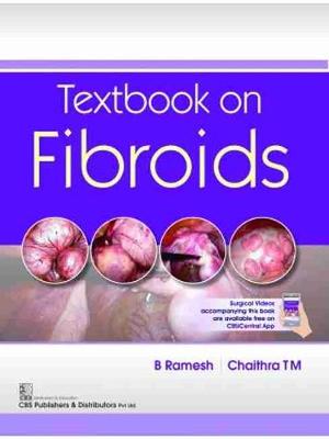 Textbook on Fibroids - Chaithra, T M, and Ramesh, R