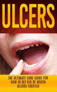 Ulcers: The Ultimate Cure Guide for How to Get Rid of Mouth Ulcers Instantly