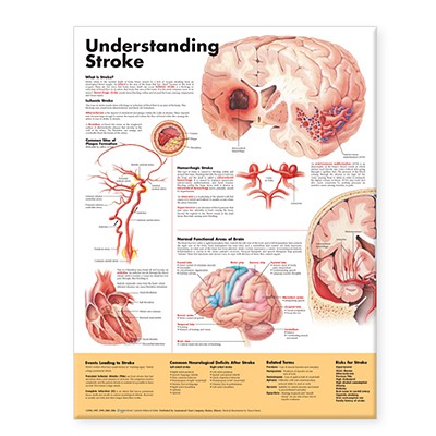 Understanding Stroke Anatomical Chart - Anatomical Chart Company (Prepared for publication by)