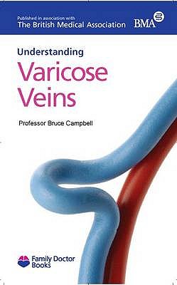 Understanding Varicose Veins - Campbell, Bruce